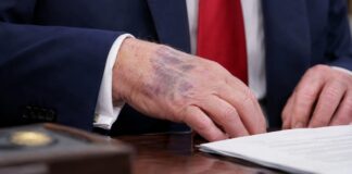 Trump Remains Active Despite Hand Condition Concerns